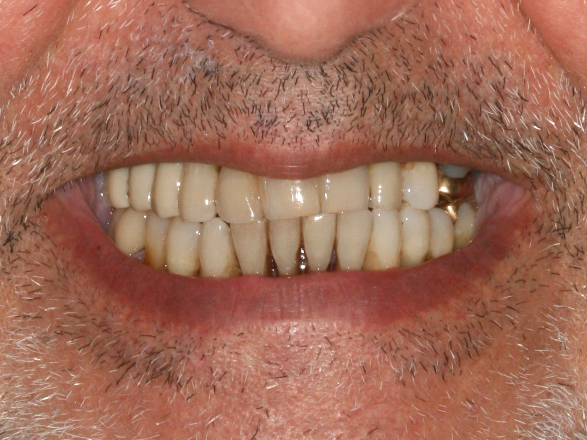 Dental Implant Before: Dr. Craig Horton Envision Greenville, SC