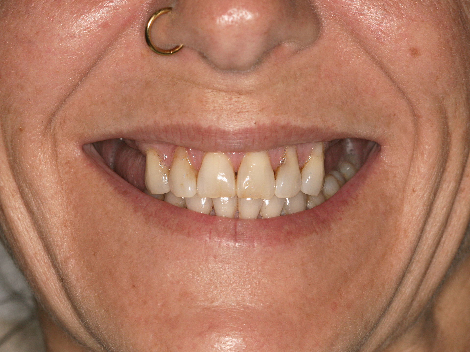 Dental Implant Before: Dr. Craig Horton Envision Greenville, SC
