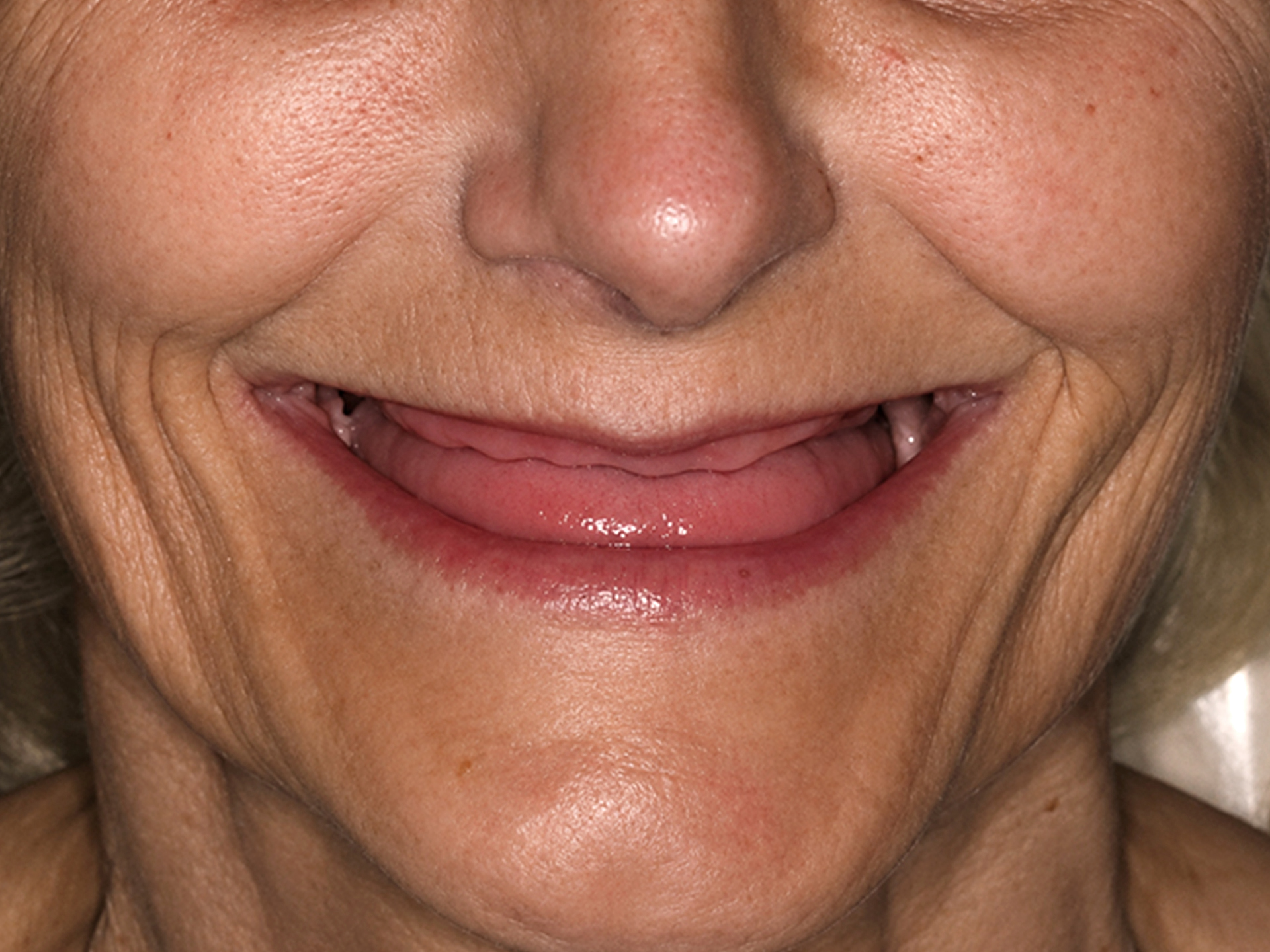 Dental Implant Before: Dr. Craig Horton Envision Greenville, SC